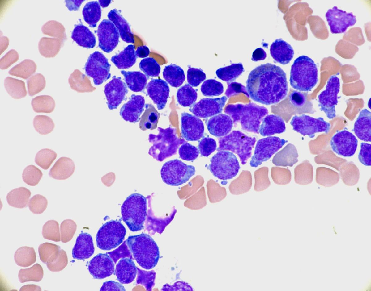Bone marrow aspirate showing erythroid dysplasia